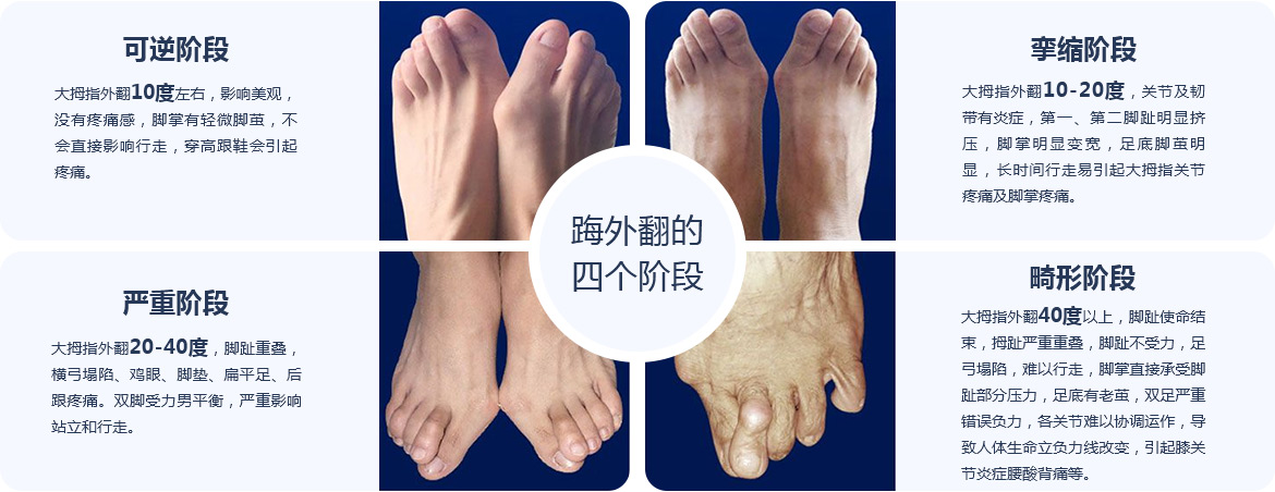踇外翻的四個階段