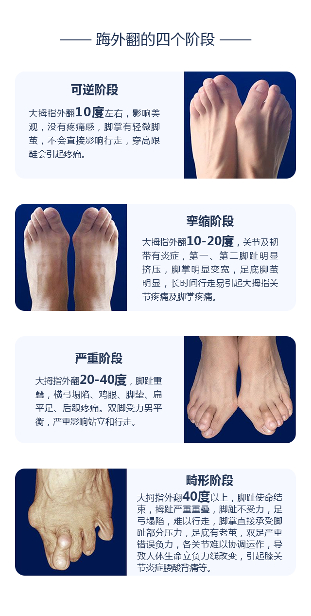 踇外翻的四個階段