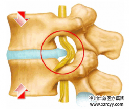 【脊柱】腰突不看年齡，生活習(xí)慣是關(guān)鍵！