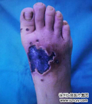 長(zhǎng)了“刺瘊子”怎么辦？輕信“偏方”不僅治不了病，可能還會(huì)害了你