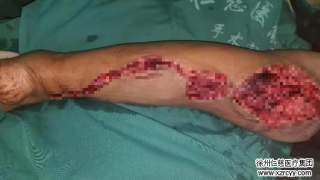 車禍傷后10小時(shí)，奔波500里，原本要截肢的腿在這保住了！