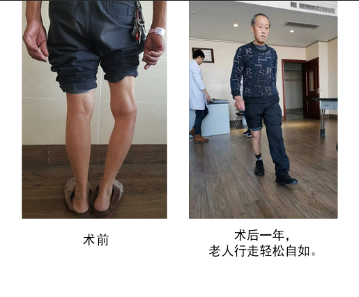 仁慈關節(jié)