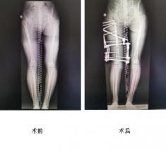 花季少女跛行15年，仁慈骨科利用Ilizarov技術(shù)幫其健康行走
