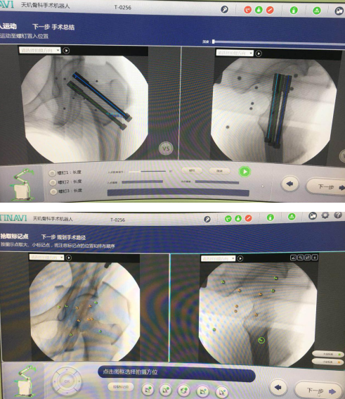仁慈骨科機器人