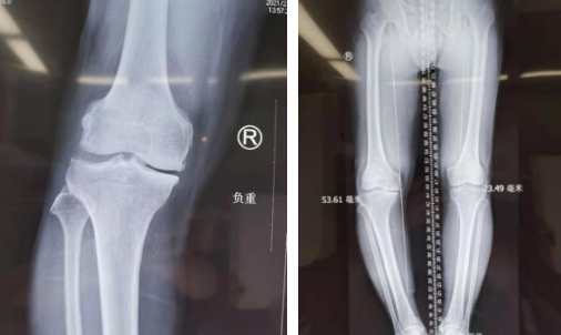 骨科機器人