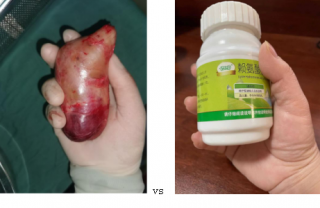 又遇到一個鎖骨下長瘤子的患者，這種病要注意了！