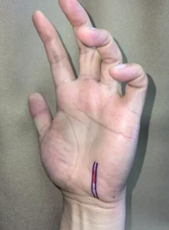 騎行60公里，她“累”到捏不起筷子 | 這是神經(jīng)損傷，可能需手術(shù)！